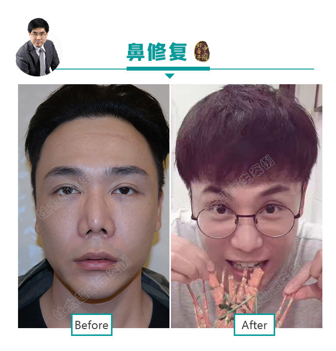 “因鼻制宜” 鼻子整形的全攻略赶紧来了解一下吧