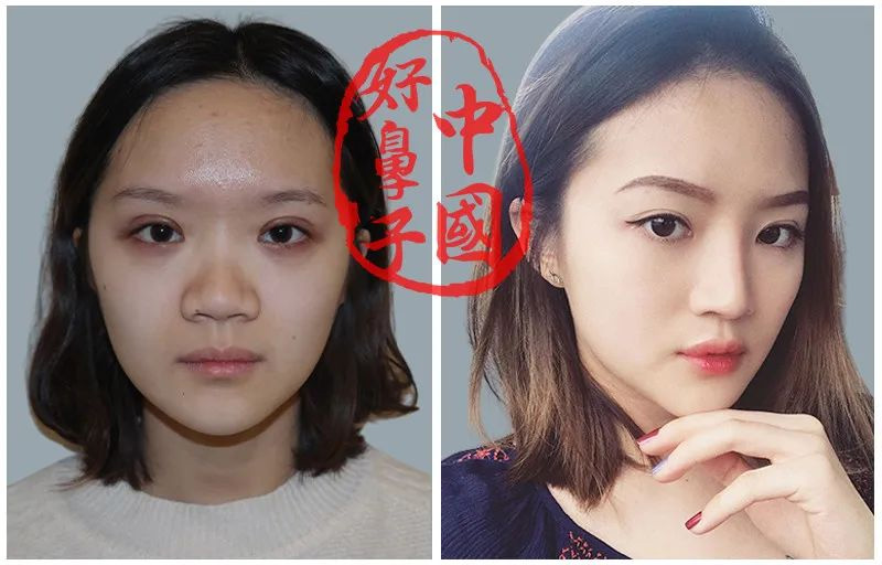 鼻整形为什么那么难？