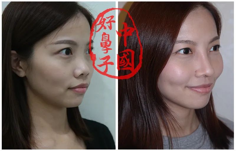 鼻尖塑形不建议用哪些材料呢？