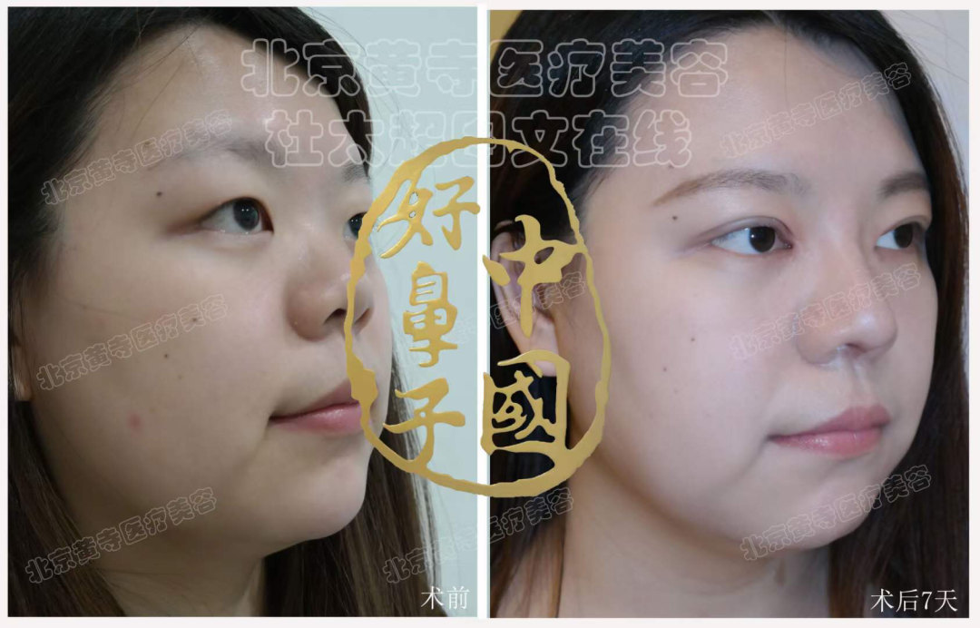 鼻基底填充存在哪些风险？