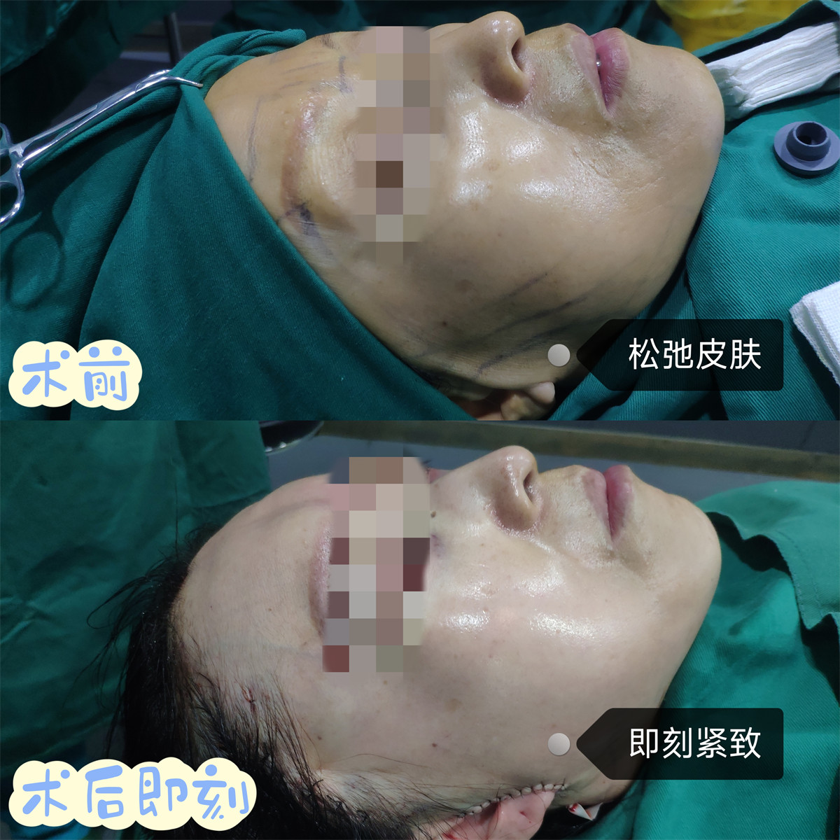 拉皮手术和去眼袋一起做,术后年轻10岁有余! 拉皮手术和去眼袋一起做,术后年轻10岁有余!