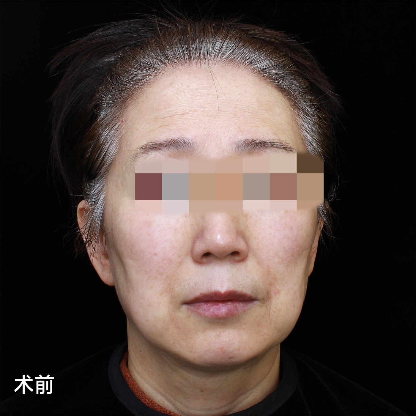 总被问有没有60岁!不甘心做了拉皮手术,第7天拍照,很惊喜 总被问有没有60岁!不甘心做了拉皮手术,第7天拍照,很惊喜