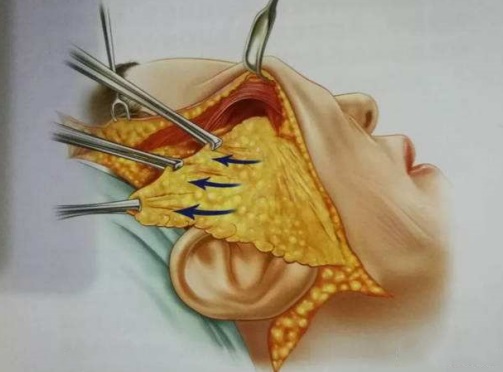 总被问有没有60岁!不甘心做了拉皮手术,第7天拍照,很惊喜 总被问有没有60岁!不甘心做了拉皮手术,第7天拍照,很惊喜