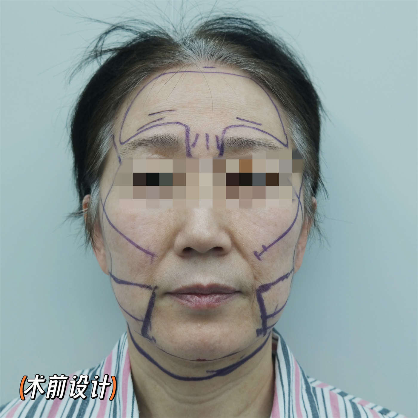 总被问有没有60岁!不甘心做了拉皮手术,第7天拍照,很惊喜 总被问有没有60岁!不甘心做了拉皮手术,第7天拍照,很惊喜