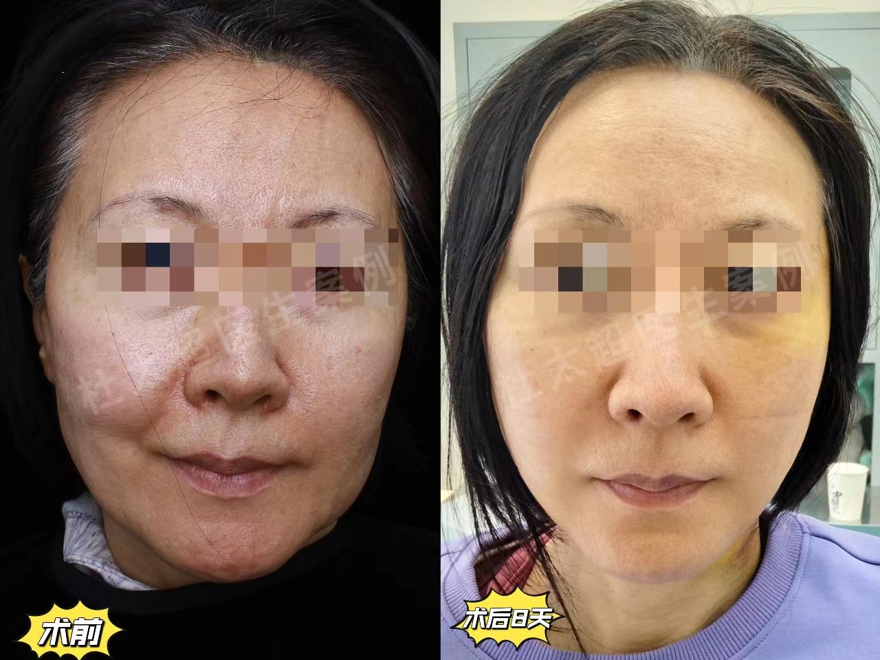 面部提升怎么选？选线雕、热玛吉还是拉皮手术，过来人谈谈经验