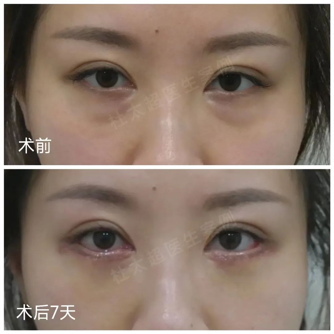 我做了微创去眼袋，只用了7天恢复，眼周重现年轻态！