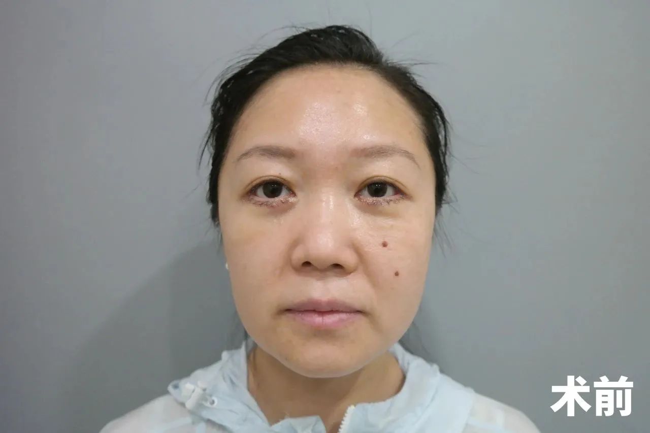 36岁求美者，拉皮手术亲身经历，有效改善法令纹和皮肤松弛问题！
