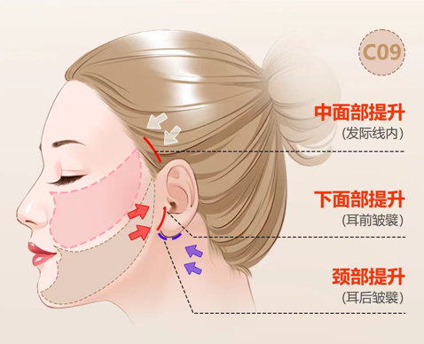 做拉皮手术需要多少钱？