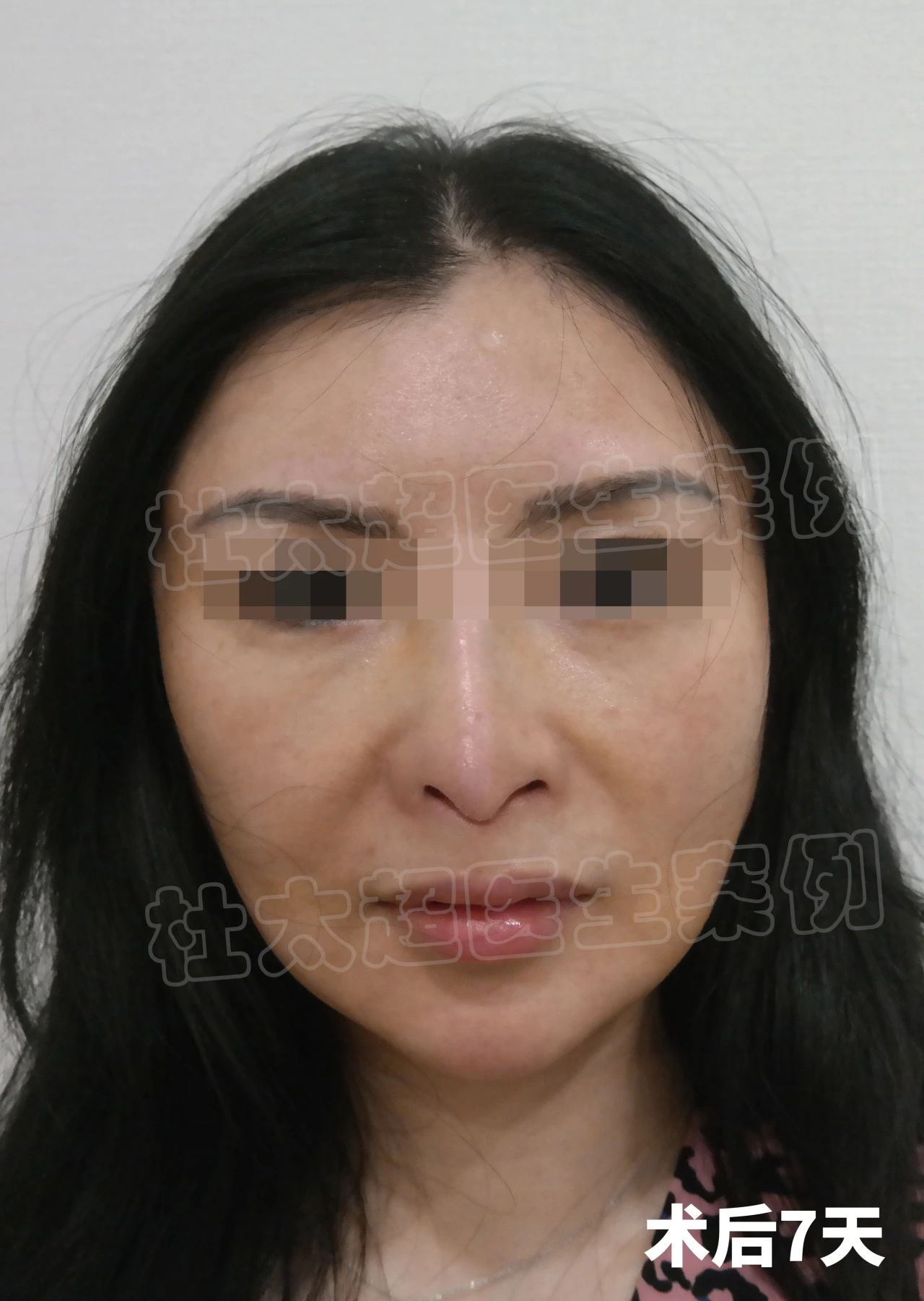 真实记录|45岁拉皮手术，术后表示很满意，安全变美不踩坑！