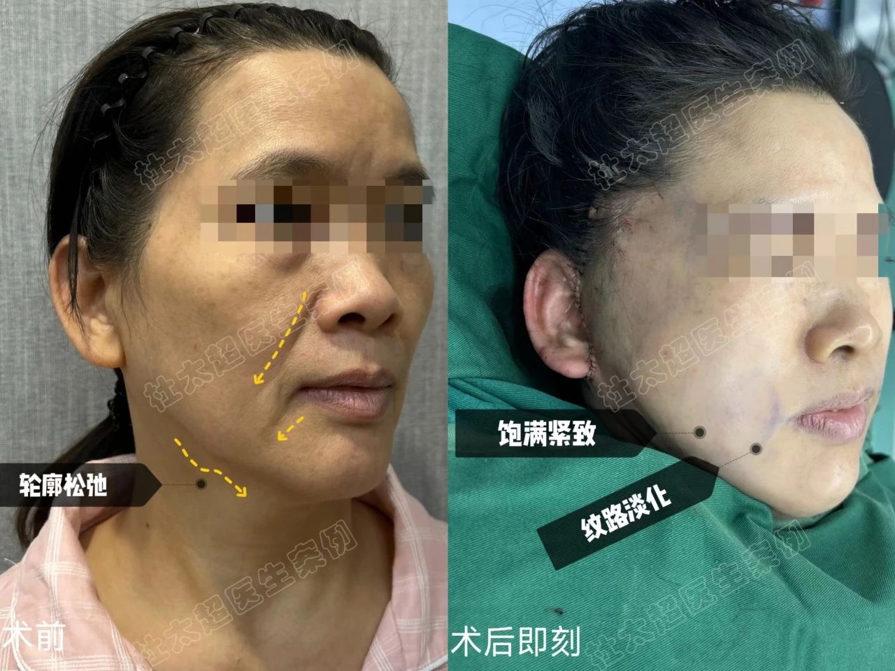 52岁的我通过亲身经历，分享拉皮和切眉手术的全过程！