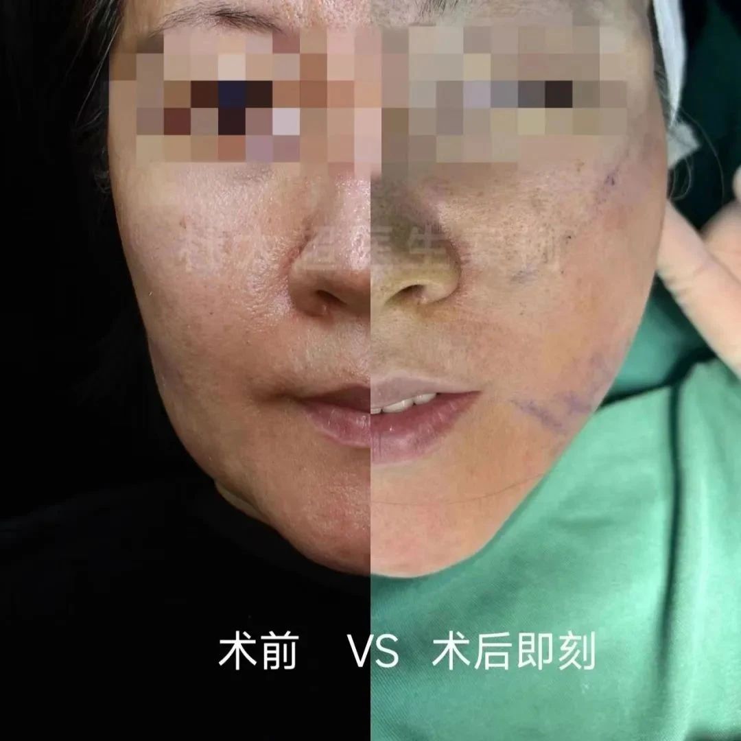 太惊讶了！拉皮手术优惠这么多，她居然拒绝选择...