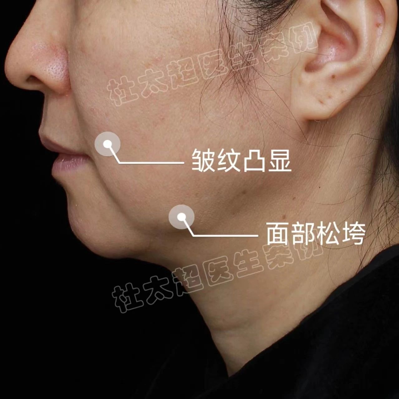 皮肤松弛导致口周老化明显，这样做改变整体的“年轻态”！