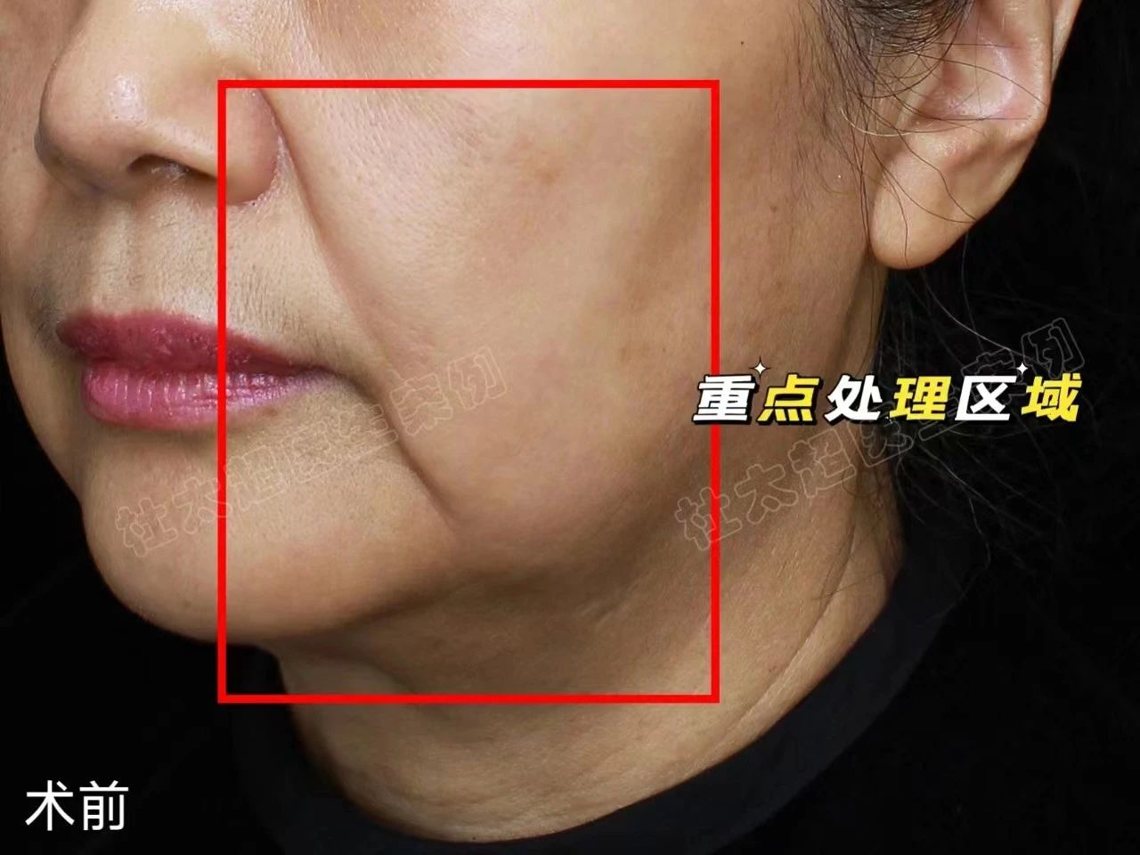 拉皮手术能解决什么问题？来看看我的拉皮心路历程！