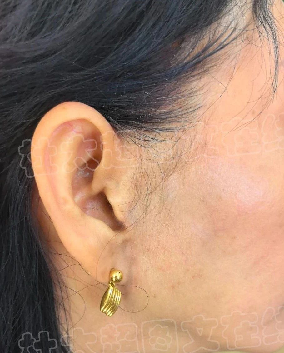 想尝试拉皮手术？先看看这位54岁美容爱好者的一年后反馈！