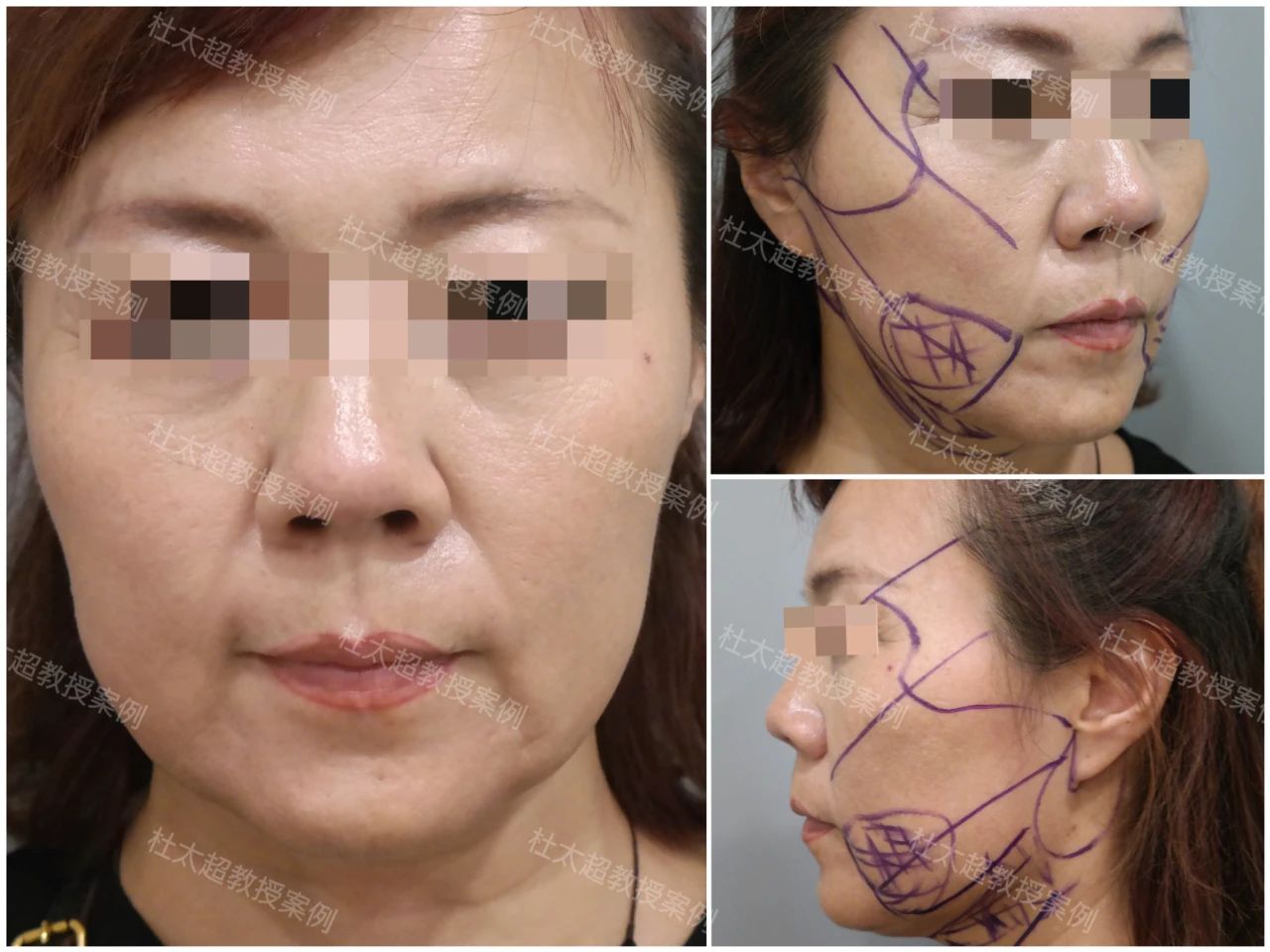 56岁女士拉皮手术后5个月最新素颜照，这状态堪比40多？