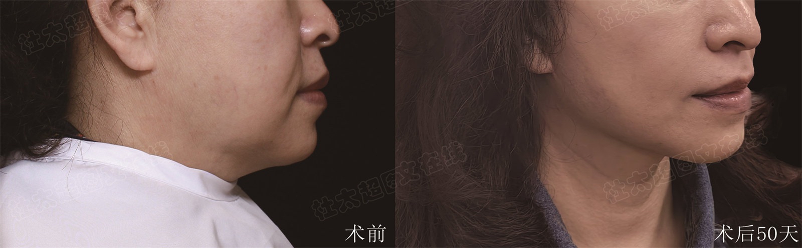 不接受自己变老，又抵制医美，这不自己遭罪吗？