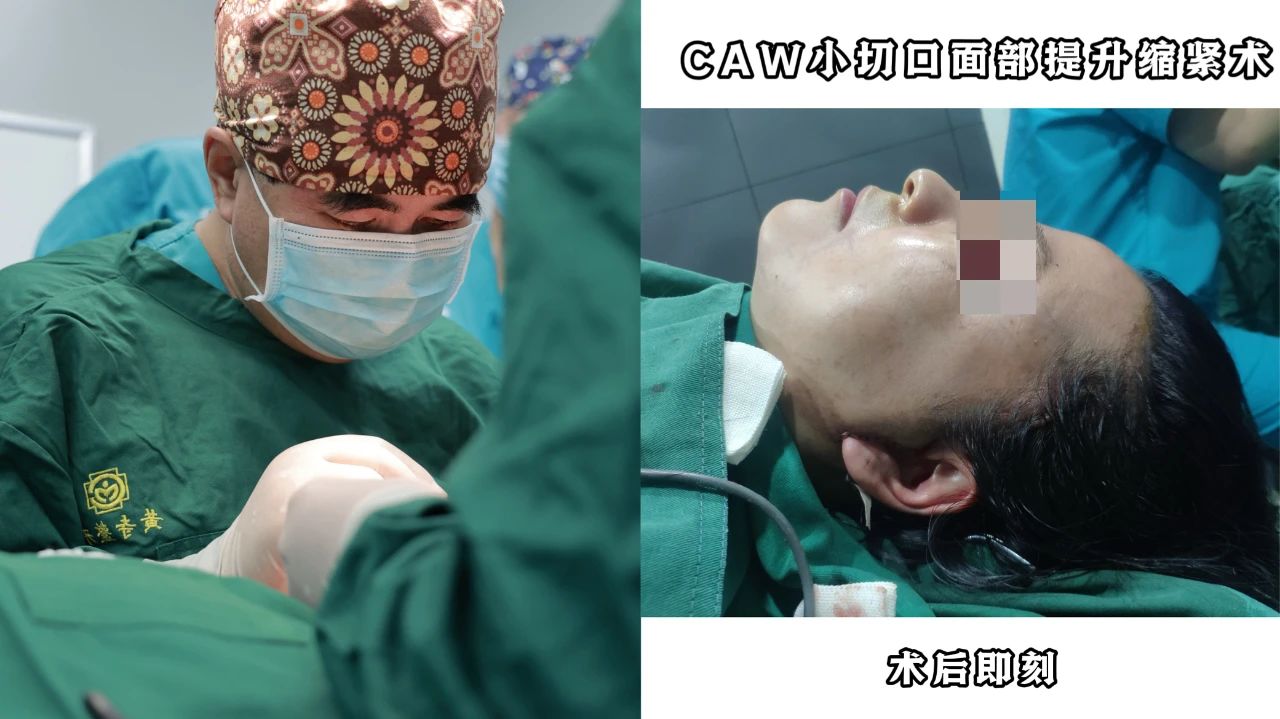 54岁求美者caw小切口拉皮手术：即刻、2个月及四年惊艳效果展示