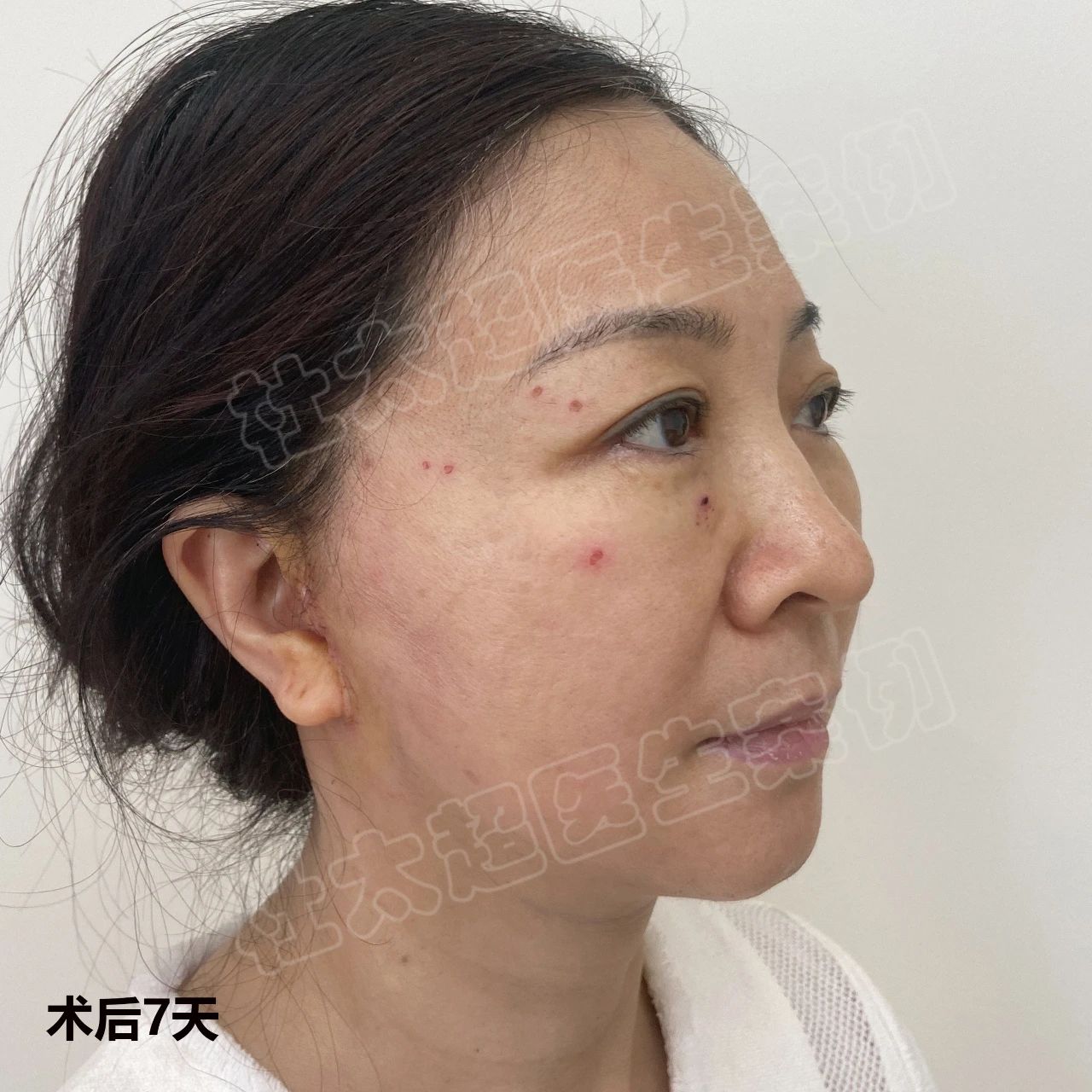 拉皮手术：caw小切口面部提升缩紧术四大特殊优势你知道吗？