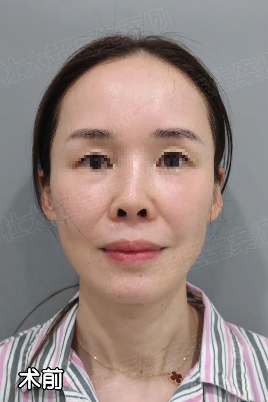 48岁在北京做拉皮手术到底花了多少钱？!7天从“黄脸婆”到“大飒蜜”的她，直言中年人就该薄情一点！