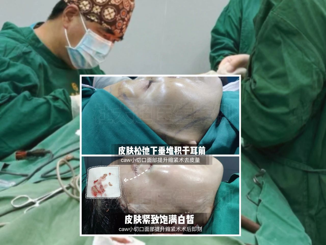 68岁拒绝被叫奶奶，实测3小时拉皮手术的逆龄回春!7个月后自称"小姑娘"...